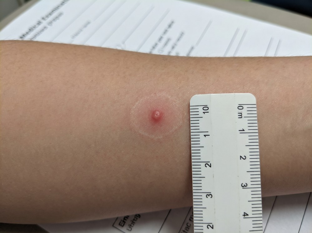 Close-up of a fresh bite mark showing two small red bumps positioned close together with mild surrounding redness and swelling