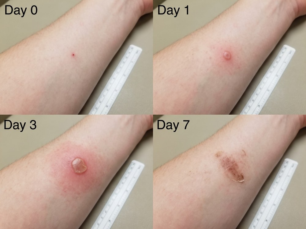 Side by side labeled comparison photograph of a yellow sac spider bite next to a brown recluse spider bite
